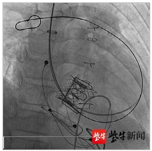 瓣膜|江苏首例!省人医专家应用“干瓣”新技术为患者置换“心门”