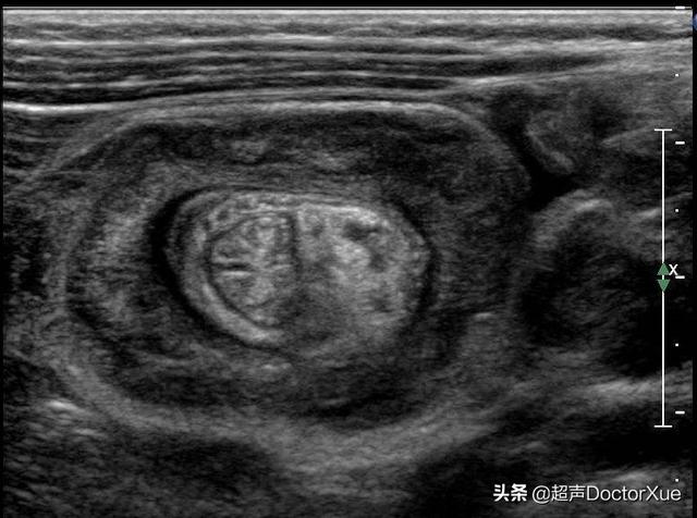 你的育儿经▲小儿阵发性腹痛呕吐，警惕肠套叠
