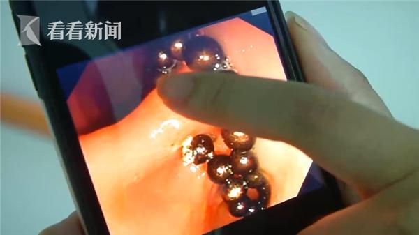 光明网|3岁娃误吞19颗磁力珠 怕爸妈责备竟说只吃了1颗