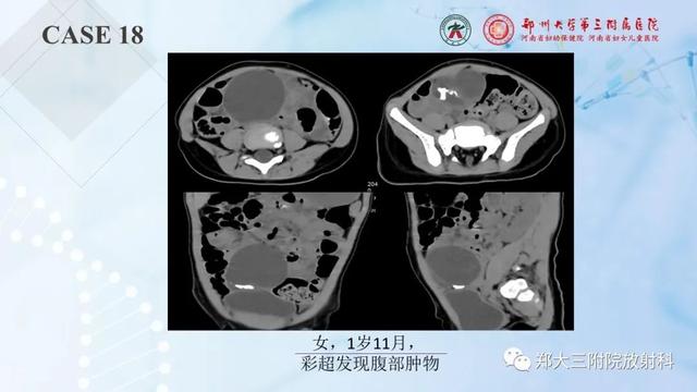 儿童腹部囊性病变诊断思路分析