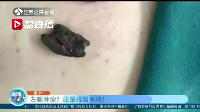 男子发现左腿里有大肿块，担心是“肿瘤”一查是残留了40年的木块