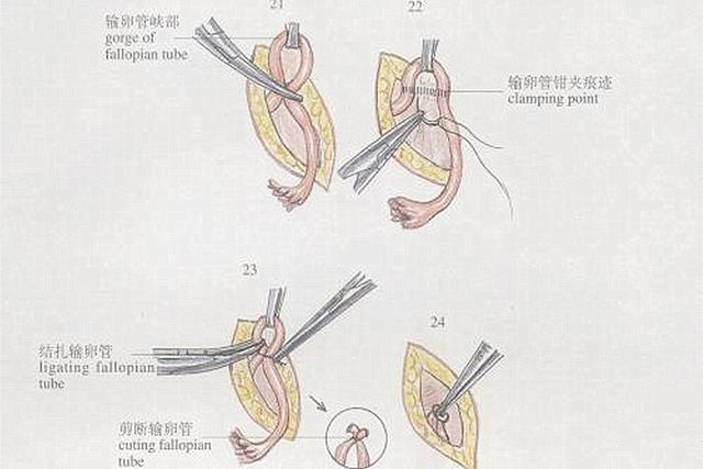 [天使宝贝]生完二胎后，应不应该顺便把“私人问题”一起解决，过来人这样说