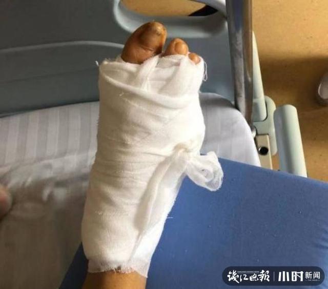 糖尿病足|杭州大伯剪个趾甲竟导致截趾！这类人群要特别当心