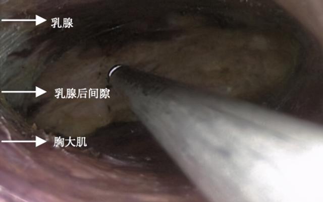 既切肿瘤又保乳房！乳腔镜为何未普及？医生说出原因