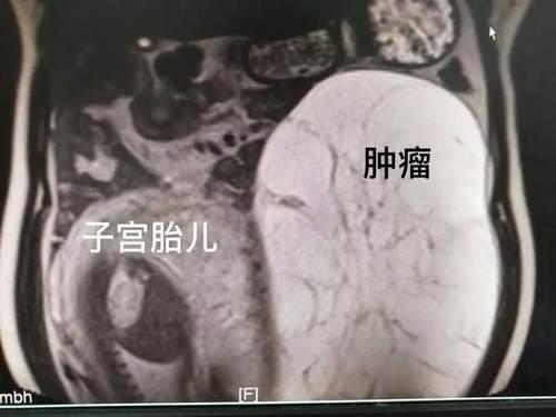 「你的育儿经」25岁泉州姑娘长肿瘤后怀孕 腹中肿瘤与胎儿“比长个”