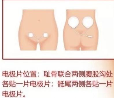 耻骨|产后疼痛，警惕“耻骨联合分离”