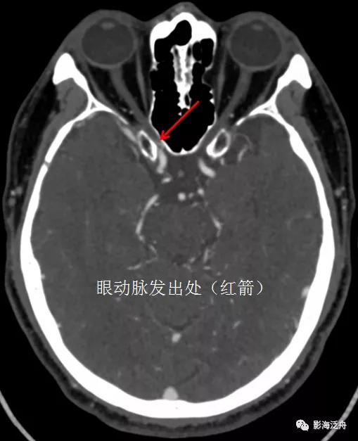 超实用的颈内动脉CTA分段