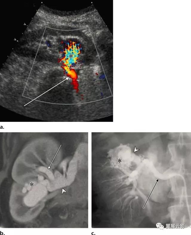 24张图汇总「肾血管」常见病变的影像学表现
