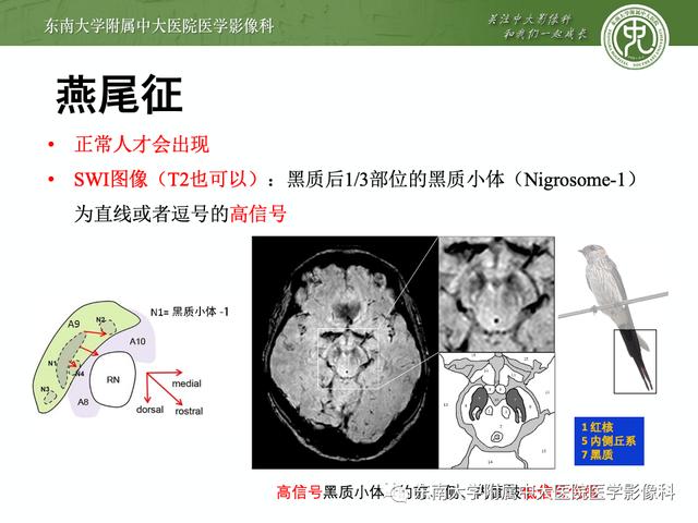 SWI的成像原理及相关病例随访