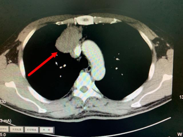 胸腔里悄悄长了一个比拳头还大的肿瘤，每年这个常规动作很重要
