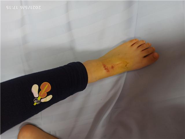 女孩在商场厕所摔倒后 脚背被"神秘液体"灼伤