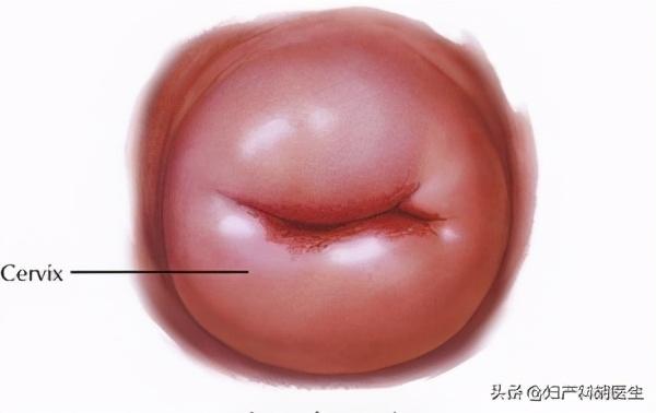 辟谣：看宫颈形状能分辨做过流产？真相在这里