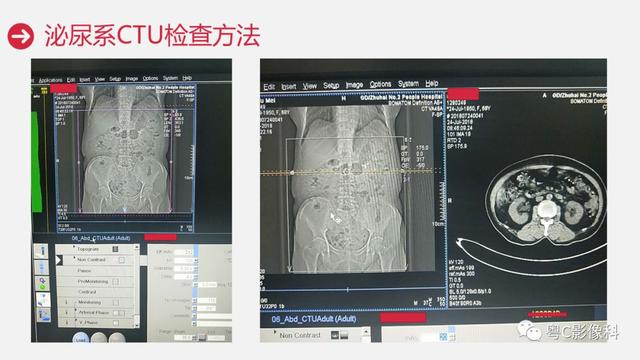 泌尿系CTU扫描技术