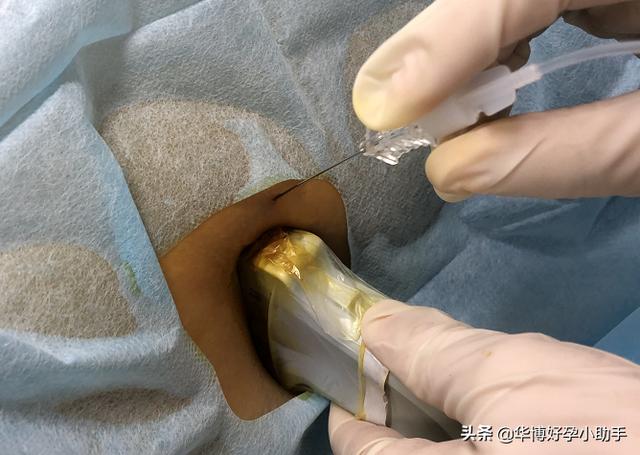 梦的色彩|据说肉肉多，生孩子不能打无痛？
