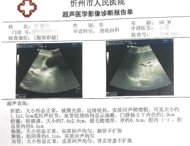 肝脏好不好，看脸就知道！这些“肝病面容”的特征，你知道多少？