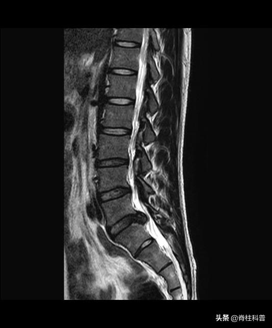 影像学|X光看不清，CT辐射大，腰突只想做最贵的核磁共振，为什么不行？