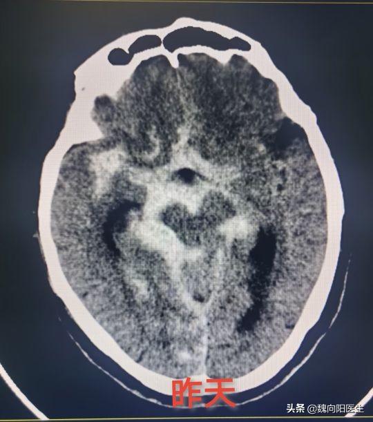 脑梗死非得要做核磁才能发现吗？做CT行不行？