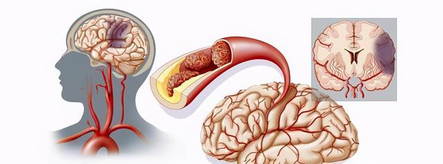 脑梗恢复需要时间，有时还会留下永久的后遗症，该如何预防呢？