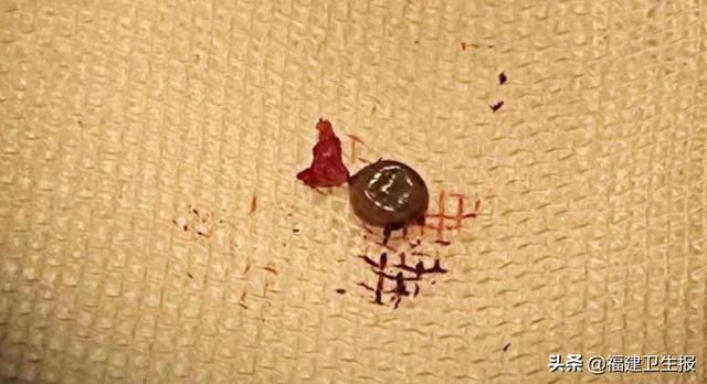 皮肤|福州女子眼角长了个“肉球”，一查竟是活虫！这种虫严重可致死