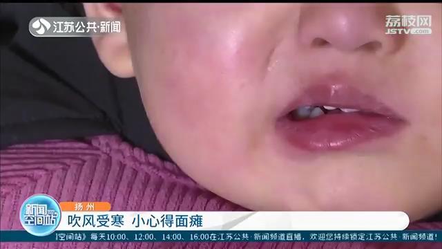 寒潮袭来注意防寒保暖！扬州两岁女童吹风受寒得面瘫