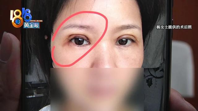 女士|双眼皮手术以后，左眼成了“三角形”？