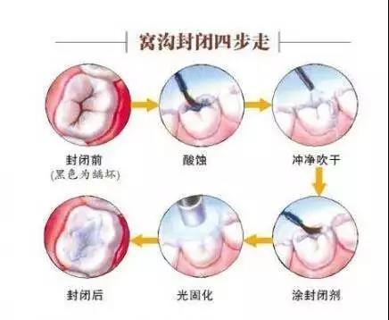 【健康学堂】孩子几岁开始刷牙？牙膏用量如何把握？