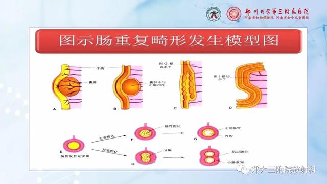 儿童腹部囊性病变诊断思路分析