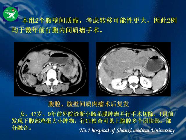 李健丁教授：胃肠道外间质瘤的CT表现和临床病理分析