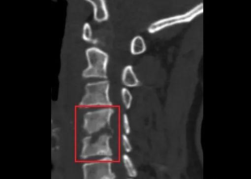 颈椎|惊悚！因为这，阿姨两节颈椎被“吃掉”，差点瘫痪…