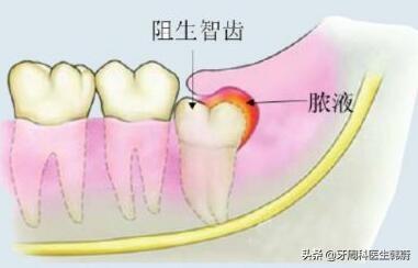 高考生家长们请关注：临考前最容易犯、且严重影响成绩的牙病