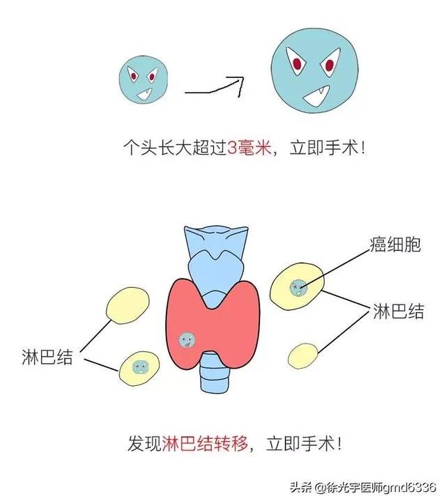 小于1厘米的微小癌，可以观察不手术？看看专家是怎么建议的