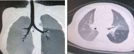 [你的育儿经]青岛2岁男孩反复咳嗽，父母没及时带其去医院！医生：轻则感染，重则致命！