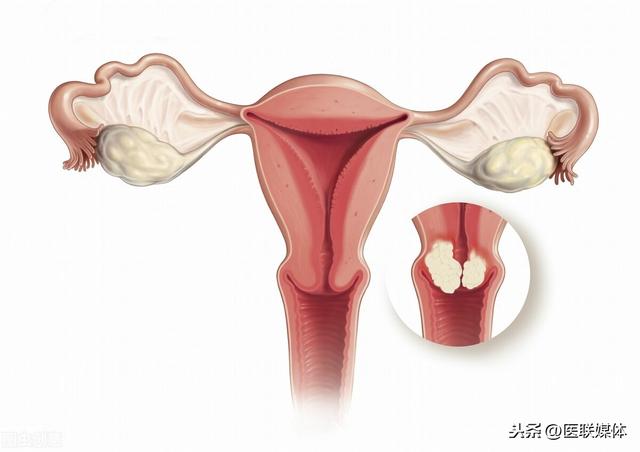 这4种癌症，刚开始可能容易被误诊，看完要多留个心眼