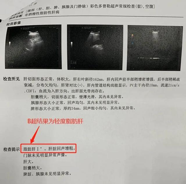 金牌大叔|11岁娃从小胃口好？被确诊重度肝硬化！竟和这“小事”有关