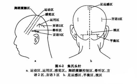 「你的育儿经」头皮针在小儿脑性瘫痪中的临床应用