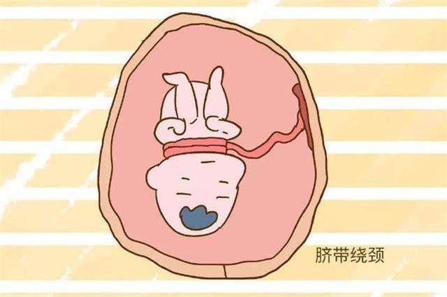 [你的育儿经]谢依霖二胎，发现宝宝脐带打结后怕不已，脐带的这些事孕妈必学
