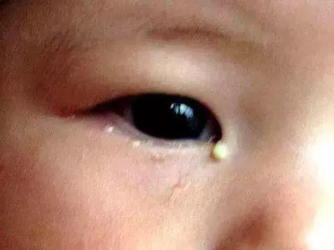 『你的育儿经』宝宝眼泪多、眼部分泌物多、眼周湿疹，如何轻松在家搞定