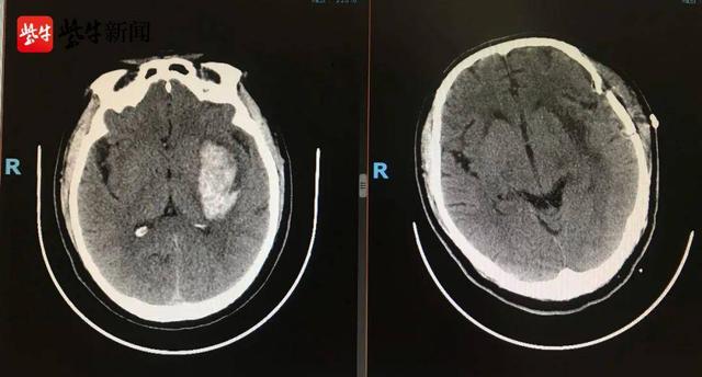 脑出血|忽视血压控制，突发性脑出血盯上年轻人