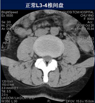 腰椎间盘CT诊断：椎间盘膨出、突出、椎管狭窄及退行性病变