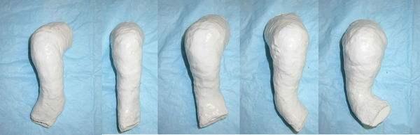 「你的育儿经」马蹄内翻足治疗方法？