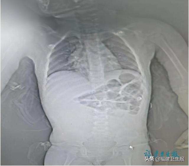 休克|宁德2岁女童呕吐两天后，肠子被部分切除！医生：呕吐严重可致命