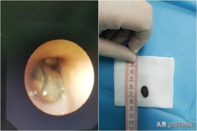 超级宝妈▲湖南一6岁女童“感冒”两年未好，元凶竟是一颗西瓜籽？