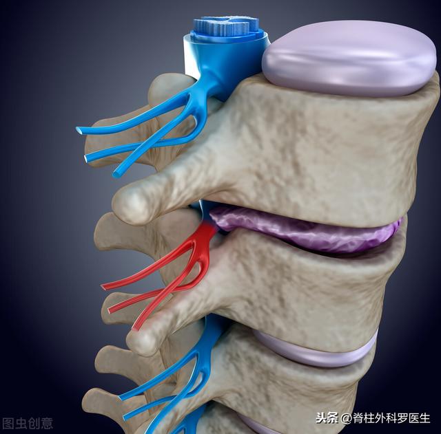 医生，我的腰是好好的，仅仅腿痛腿麻，怎么可能是腰椎间盘突出呢