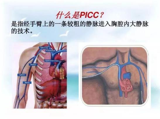 血管|菏泽曹县中医院成功开展升级版“B超引导下改良塞丁格PICC置管术”