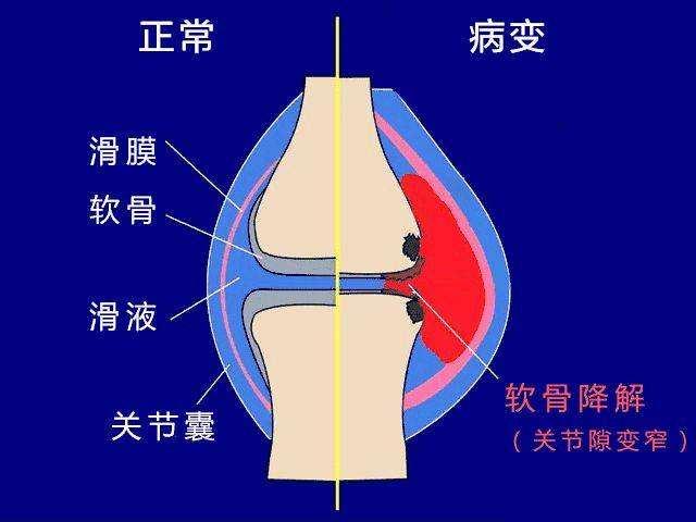 「类风湿关节炎」为何误诊「急性滑膜炎」？滑膜炎“炎”从何来？