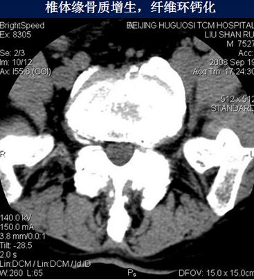 腰椎间盘CT诊断：椎间盘膨出、突出、椎管狭窄及退行性病变