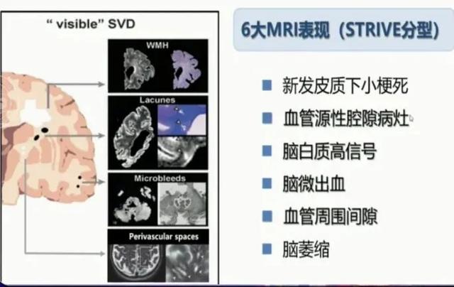 脑小血管病如何诊治？这一篇讲清楚了