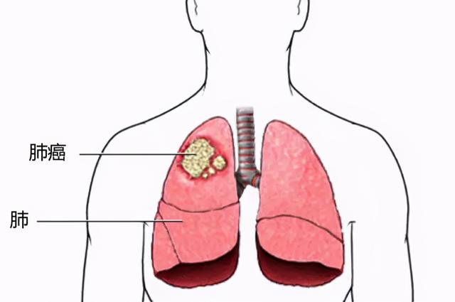 肺癌有哪些分型？肺癌细胞的行为跟正常细胞有什么不一样？