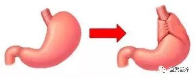 食管|经常反酸烧心是“门”没关紧