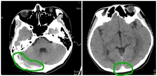 16岁少年突发脑卒中，出现这些症状千万要警惕